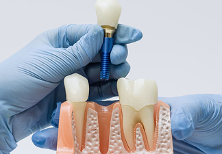 Dental Implants